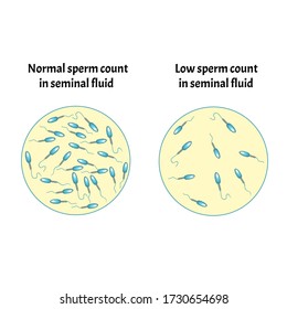 Low sperm count in seminal fluid. Low abundance of sperm in the ejaculate. Male infertility Oligospermia. Spermogram. pathology types. Sperm defects. structure of the sperm. Infographics Vector.