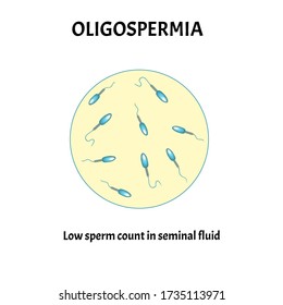 Recuento bajo de esperma en fluido seminal. Baja abundancia de esperma en el eyaculado. Infectilidad masculina Oligospermia. Spermograma. tipos de patología. Defectos espermáticos. estructura del esperma. Vector de infografía.