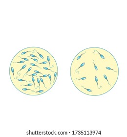 Recuento bajo de esperma en fluido seminal. Baja abundancia de esperma en el eyaculado. Infectilidad masculina Oligospermia. Spermograma. tipos de patología. Defectos espermáticos. estructura del esperma. Vector de infografía.
