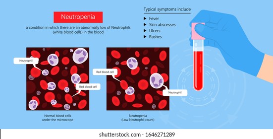 Low White Blood Cell Count Leukopenia Diagnostic Fight Sepsis Virus Bone Marrow Aplastic Anemia Illness Check Destroy Bacteria