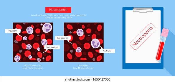 Low White Blood Cell Count Leukopenia Diagnostic Fight Sepsis Virus Bone Marrow Aplastic Anemia Illness Check Destroy Bacteria