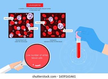 Low White Blood Cell Count Leukopenia Diagnostic Fight Sepsis Virus Bone Marrow Aplastic Anemia Illness Check Destroy Bacteria