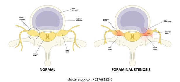 lower back hip pain Bone lumbar canal physical therapy spurs local neck disk neural hernia heavy Paget’s facet space good poor bad root anti inflammatory drugs neural spine cord nerve block anatomy