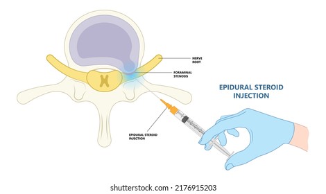 lower back hip pain Bone lumbar canal physical therapy spurs local neck disk neural hernia heavy Paget’s facet space good poor bad root anti inflammatory drugs neural spine cord nerve block anatomy