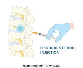 lower back hip pain Bone lumbar canal physical therapy spurs local neck disk neural hernia heavy Paget’s facet space good poor bad root anti inflammatory drugs neural spine cord nerve block anatomy