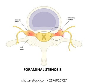 lower back hip pain Bone lumbar canal physical therapy spurs local neck disk neural hernia heavy Paget’s facet space good poor bad root anti inflammatory drugs neural spine cord nerve block anatomy