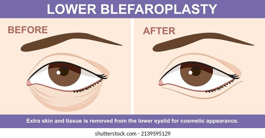 Lower  Blepharoplasty of eyelid , before and after. Vector illustration with plastic eyelid surgery. Infographics with icons of plastic surgery procedures. 