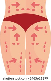 lower body lift procedure concept, remove redundant and saggy skin from Back vector flat design, plastic surgeon Symbol body contouring Sign Beauty treatment stock illustration
