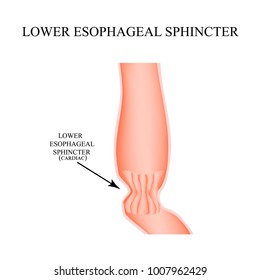 Lower Cardiac Esophageal Sphincter. Infographics. Vector Illustration On Isolated Background.