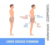 Lower crossed syndrome medical diagram. Crooked man with muscle strength imbalance. Weak and overactive pelvis muscles therapy. Incorrect spine curvature caused by bad posture. Vector illustration.