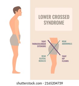 Lower crossed syndrome medical diagram. Crooked man with muscle strength imbalance. Weak and overactive pelvis muscles therapy. Incorrect spine curvature caused by bad posture. Vector illustration.