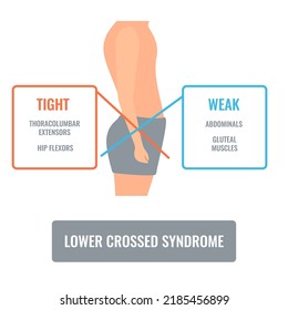 Lower crossed syndrome medical diagram. Crooked man with muscle strength imbalance. Weak and overactive pelvis muscles therapy. Incorrect spine curvature caused by bad posture. Vector illustration.