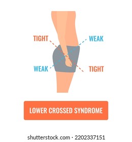 Lower crossed syndrome medical diagram. Crooked man with muscle strength imbalance. Weak and overactive pelvis muscles therapy. Incorrect spine curvature caused by bad posture. Vector illustration.