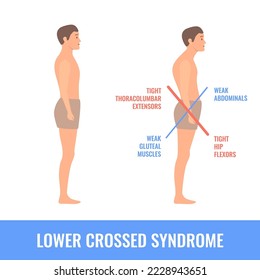 Lower crossed syndrome medical diagram. Crooked man with muscle strength imbalance. Weak and overactive pelvis muscles therapy. Incorrect spine curvature caused by bad posture. Vector illustration.