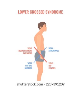 Lower crossed syndrome medical diagram. Crooked man with muscle strength imbalance. Weak and overactive pelvis muscles therapy. Incorrect spine curvature caused by bad posture. Vector illustration.