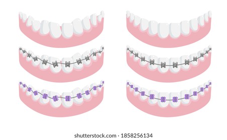 Lower jaw with healthy tooth and dental brace set. All type of metal, ceramic and invisible lingual orthodontic bracket system for teeth correction vector illustration isolated on white background