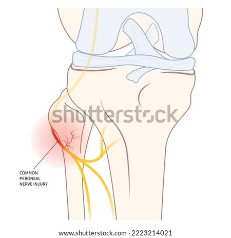 lower leg atrophy with muscle lift loss knee sciatic nerve injury of feet drop palsy and spinal cord test ankle trauma tibial fibular pain spine damage brain Stroke flex deep Neck bone common cervical Stock photo © 