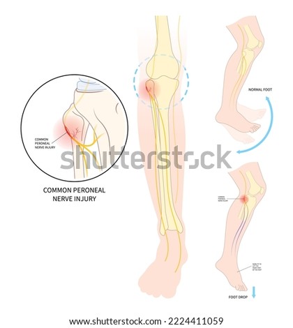 lower leg atrophy with muscle lift loss knee sciatic nerve injury of feet drop palsy and spinal cord test ankle trauma tibial fibular pain spine damage brain Stroke flex deep Neck bone common cervical Stock photo © 