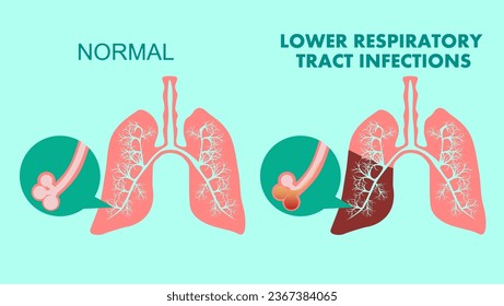 Infecciones del tracto respiratorio inferior, ilustración del vector plano