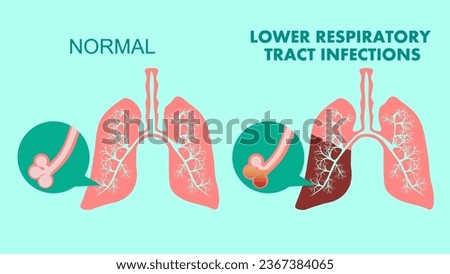 Lower respiratory tract infections, flat vector stock illustration