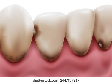 Los dientes inferiores tienen sarro y placa. Causa mal aliento y caries. Archivo de Vector de ilustración realista.