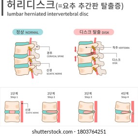 lumbar herniated intervertebral disc,damaged discs, dislocations,protrusion, escape, coronary artery, ruble type, spinal disc
