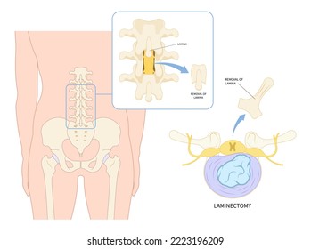 lumbar laminectomy spine cord surgery of root back pain disc tumor cancer cyst bone spurs vertebrae Muscle weakness diskectomy transforaminal compressed nerve Anterior fusion replacement annular tear