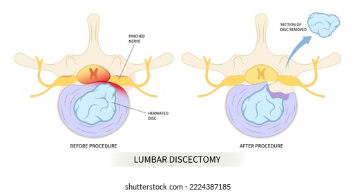 lumbar laminectomy spine cord surgery of root back pain disc tumor cancer cyst bone spurs vertebrae Muscle weakness diskectomy transforaminal compressed nerve Anterior fusion replacement annular tear