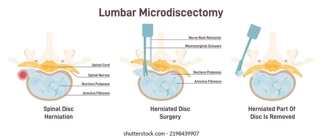 Lumbar microdiscectomy. Spinal disc herniation surgery. Removing a part of herniated disc that is irritating or inflaming the nerve root. Flat vector illustration