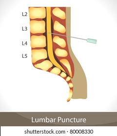 Lumbar Puncture. Detailed Diagram Of Lumbar Puncture