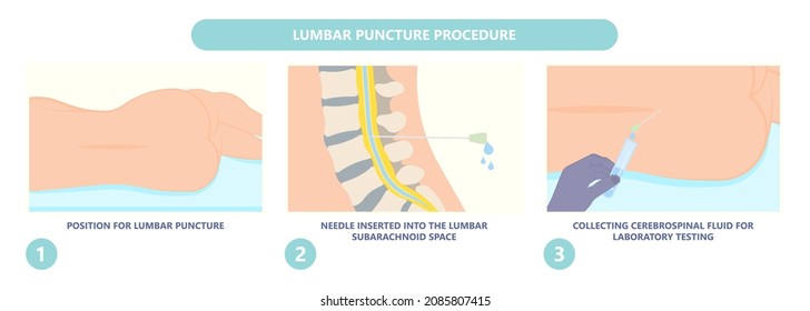 Lumbar puncture for infalmmation Bleeding cancer brain inject anaesthetic diagnosis disease disorder anaesthesia viral encephalitis syphilis