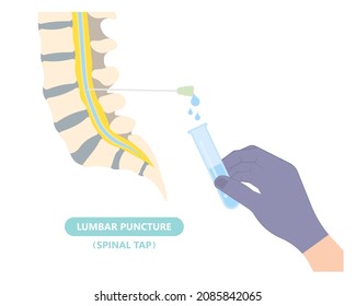 Lumbar puncture for infalmmation Bleeding cancer brain inject anaesthetic diagnosis disease disorder anaesthesia viral encephalitis syphilis