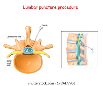 Lumbar Puncture Procedure. Spinal Nerve Roots. Spinal Tap Procedure. Close-up Of Vertebral Column. Syringe Needle Inserted Into Epidural Space To Collect Cerebrospinal Fluid. Vector 