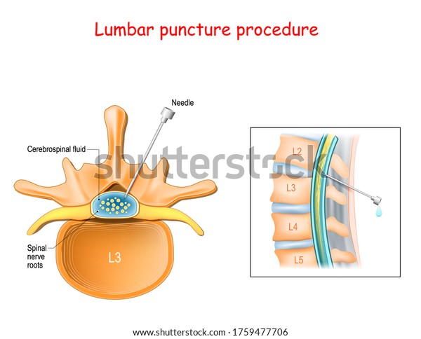 Lumbar\
puncture procedure. Spinal nerve roots. Spinal Tap Procedure.\
close-up of Vertebral Column. Syringe needle inserted into Epidural\
space to Collect Cerebrospinal Fluid. Vector\
