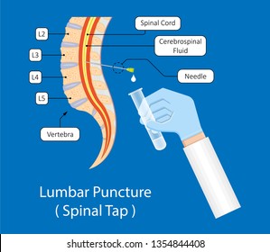 Lumbar Puncture Spinal Tap Canal Diagnostic Collect Sample Patient Treat MS Tumor Exam Drug Measure Pressure CSF Lab White Blood Cell