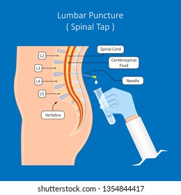 Lumbar Puncture Spinal Tap Canal Diagnostic Collect Sample Patient Treat MS Tumor Exam Drug Measure Pressure CSF Lab White Blood Cell