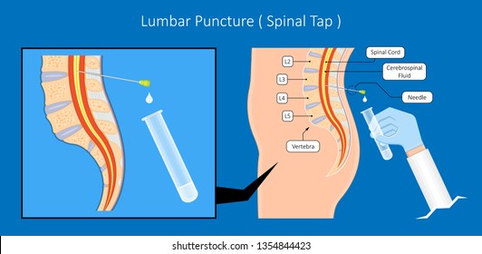 Lumbar Puncture Spinal Tap Canal Diagnostic Collect Sample Patient Treat MS Tumor Exam Drug Measure Pressure CSF Lab White Blood Cell