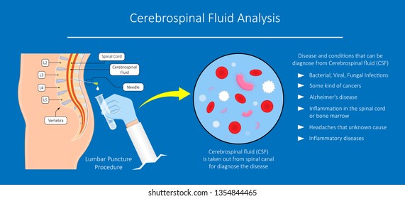 Lumbar Puncture Spinal Tap Canal Diagnostic Collect Sample Patient Treat MS Tumor Exam Drug Measure Pressure CSF Lab White Blood Cell