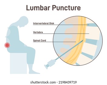 Lumbar Puncture Spinal Tap Needle Insertion Stock Vector (Royalty Free ...