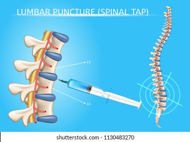 脊椎穿刺または脊椎穿刺術の医療ベクターポスターで 人間の脊柱と注射器の針を脊髄管に挿入し 脳脊髄液の解剖学的イラストを収集する のベクター画像素材 ロイヤリティフリー
