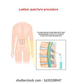 Lumbar Puncture. Spinal Tap Procedure. Detailed diagram of lumbar puncture. Human silhouette with Vertebral Column. Syringe needle inserted into Epidural space to Collect Cerebrospinal Fluid.