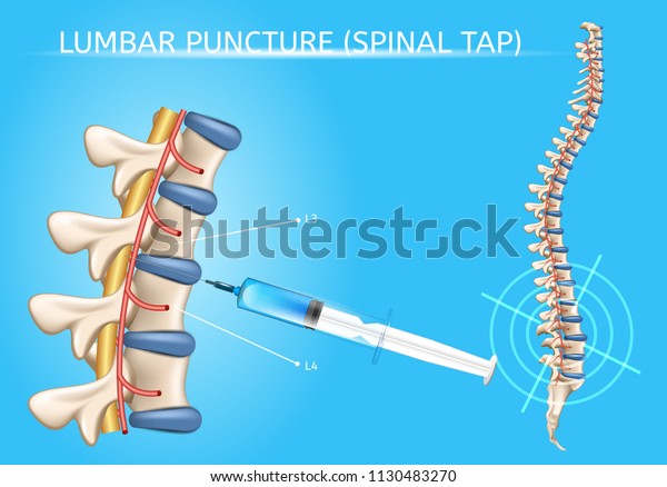 脊椎穿刺または脊椎穿刺術の医療ベクターポスターで 人間の脊柱と注射器の針を脊髄管に挿入し 脳脊髄液の解剖学的イラストを収集する のベクター画像素材 ロイヤリティフリー