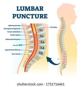 Ilustración del vector de punción lumbar. Esquema de procedimiento de punción espinal etiquetado. Examen médico de recolección de líquido con el método de la aguja. Proceso diagnóstico de enfermedad para problemas neurológicos y físicos.