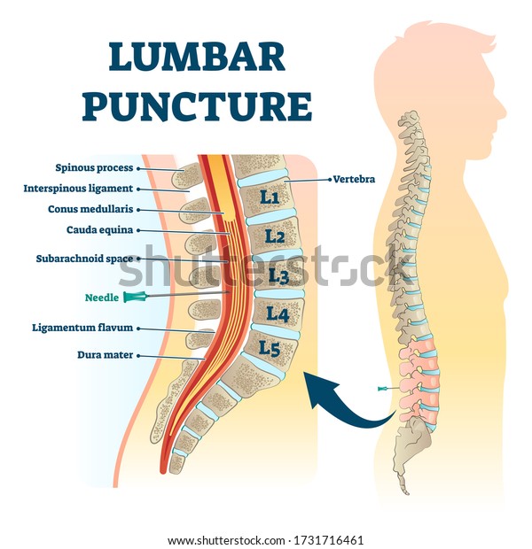 Lumbar puncture vector illustration. Labeled\
spinal tap procedure scheme. Medical fluid collecting examination\
with needle method. Diagnostic disease process for neurological and\
physical problems.