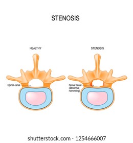 Lumbar Spinal Stenosis is an abnormal narrowing in spinal canal. section of the human vertebral column and cross-section of spinal cord. Vector illustration for medical, biological and educational use