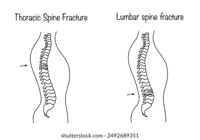 Lumbar spine fracture and Thoracic spine fracture. Violation of the integrity of the spine in the thoracic and lumbar region. A visual illustration of a human back injury. Black and white vector. 