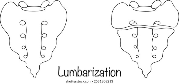 Lumbarização. Sacro saudável e separação da primeira vértebra sacral por uma placa cartilaginosa das vértebras sacrais restantes. Anomalia na estrutura da coluna vertebral. Vetor médico.