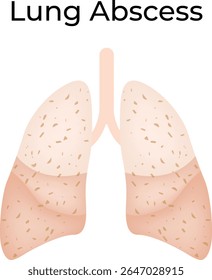 Lung Abscess: An Illustration of a Pulmonary Infection Science Design Vector Illustration Diagram