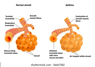 Lung Alveoli Normal And Asthma