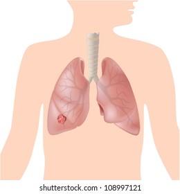 Lung cancer